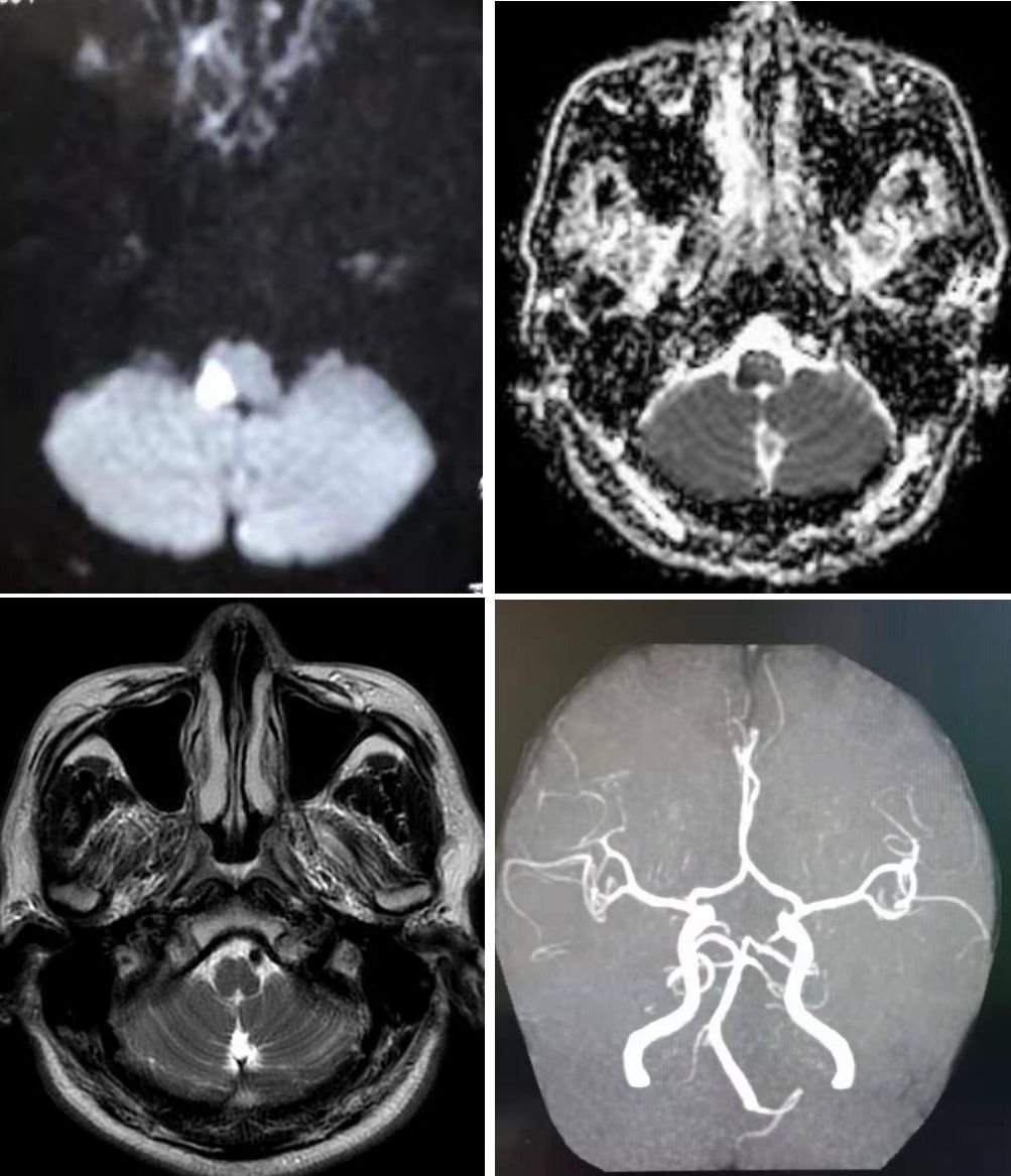 矛盾反应、Carney综合征、脑梗死、笑气中毒丨3分钟读片·第19期
