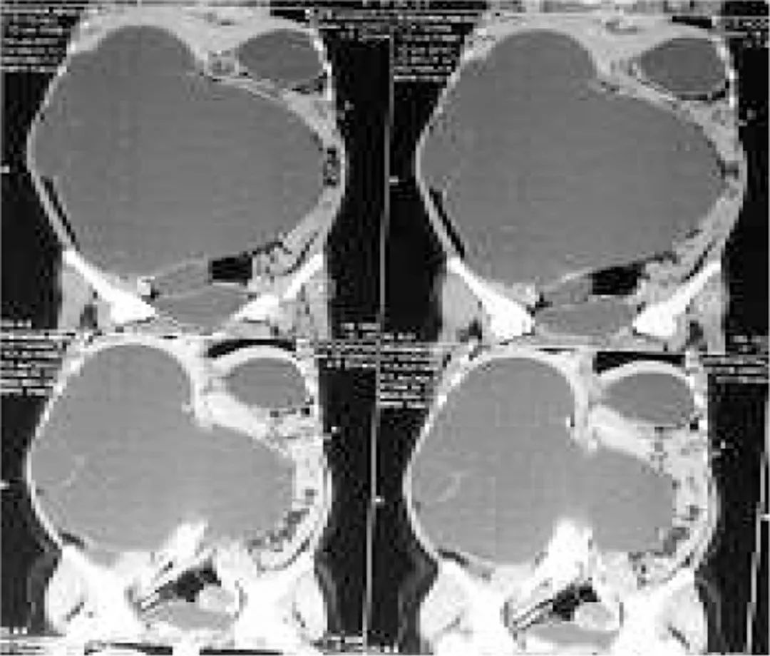 青少年巨大肾积水一例|罕见病例
