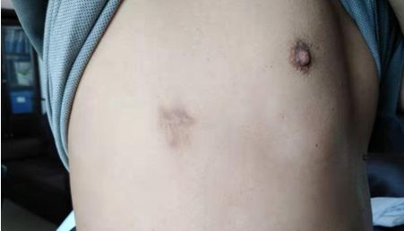 胸腔积液中医诊断是什么,胸外科微创治疗胸腔积液