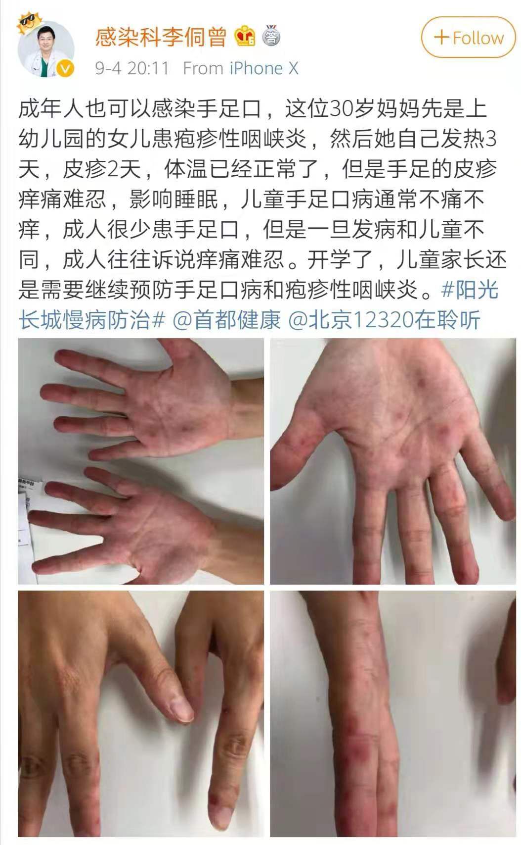 林俊杰嘴里起溃疡是什么原因,手足口不断长新疱疹