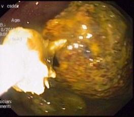 可怕!空腹吃柿子又吃红薯,六旬老人胃里取出“大柿石”