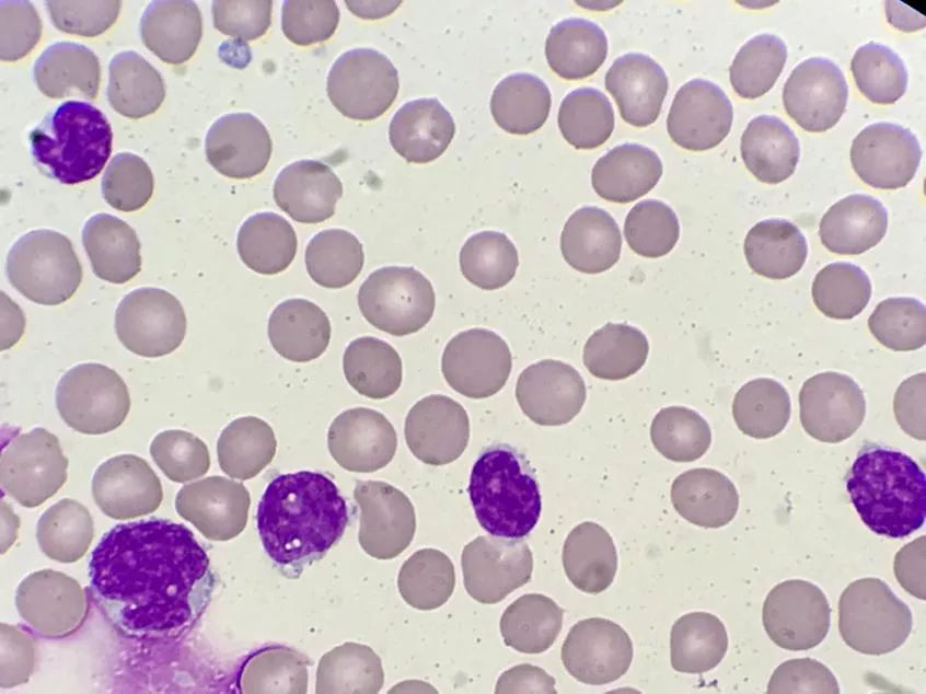 套细胞淋巴瘤胸腔侵润病例分享