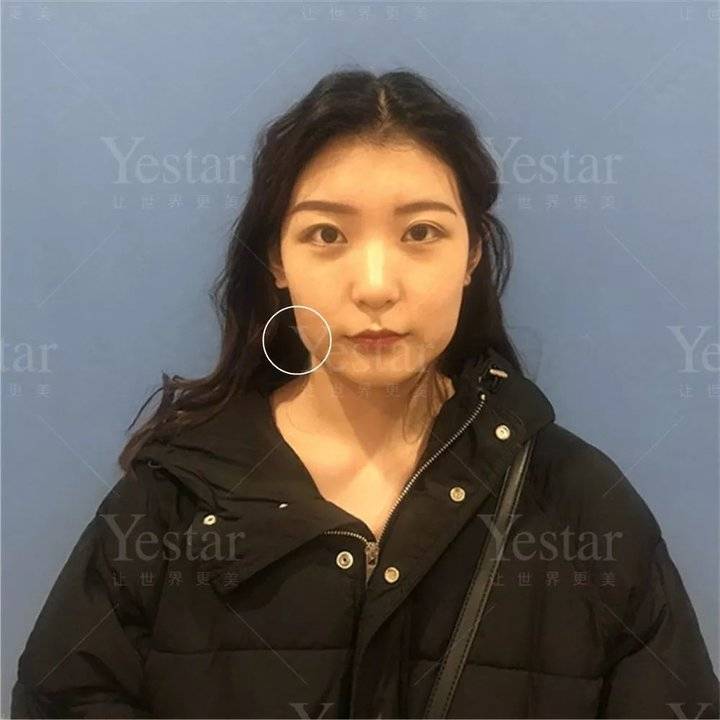 十大骗局肉毒素药,微整形注射假药案例