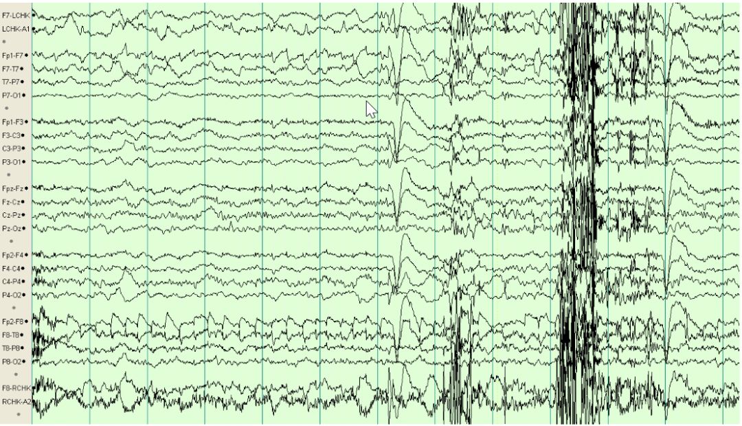 脑电图伪差图,脑电图伪差图谱