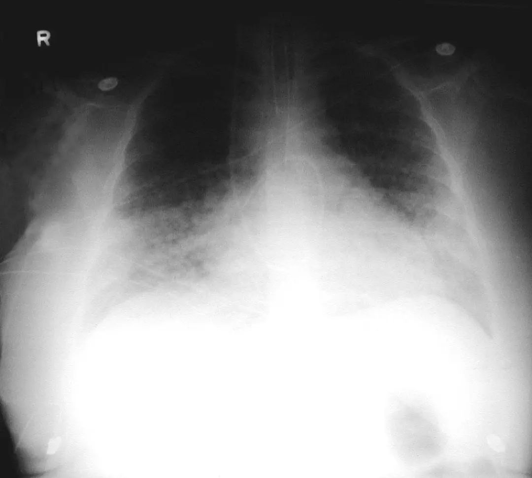 26张图，搞懂细菌性肺炎与病毒性肺炎