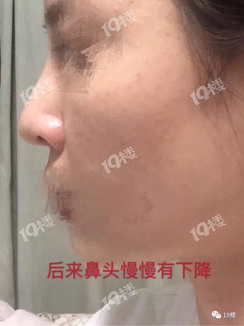 美丽女子整容失败,鼻整形失败多久可以修复