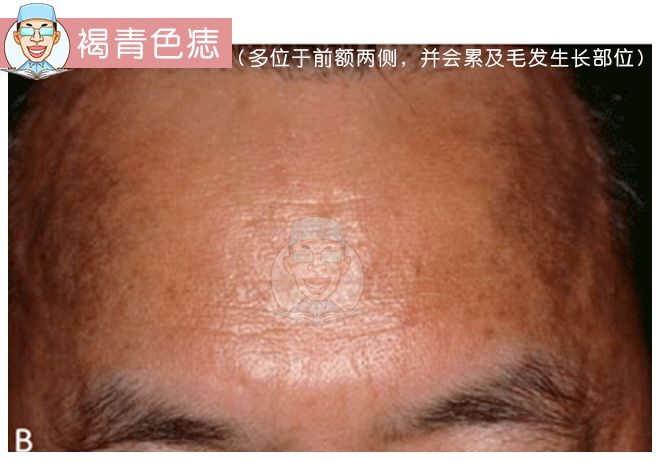 褐青色痣和斑的区别,褐青色痣斑是怎么形成的