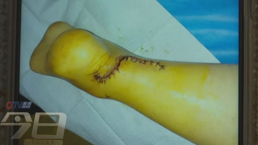 女子头部被瓷砖砸伤,女子被高空掉落瓷砖砸伤