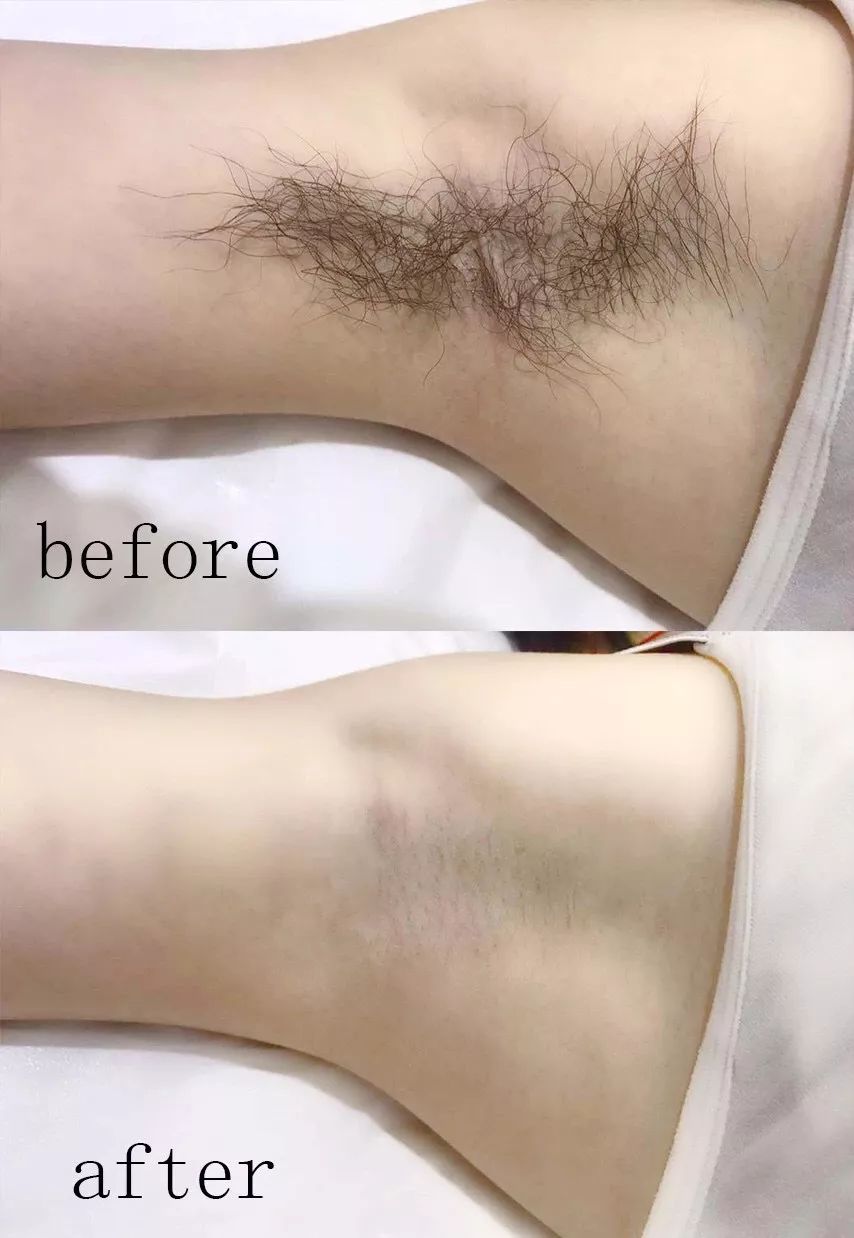 脱毛是不是秋冬季最适合,夏季脱毛便宜的方法有哪些