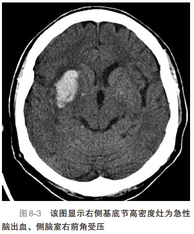 脑卒中精准tms治疗策略,急性缺血性脑卒中应对策略