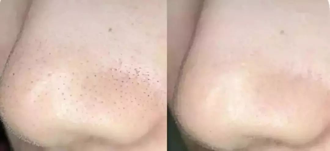 脸上搓出3斤泥！难怪又黄又暗又黑头！10秒给脸蛋“剥壳”，厉害