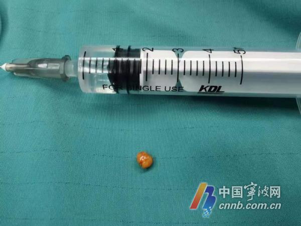 20岁宁波小伙张口困难嘴里竟然长了颗石头