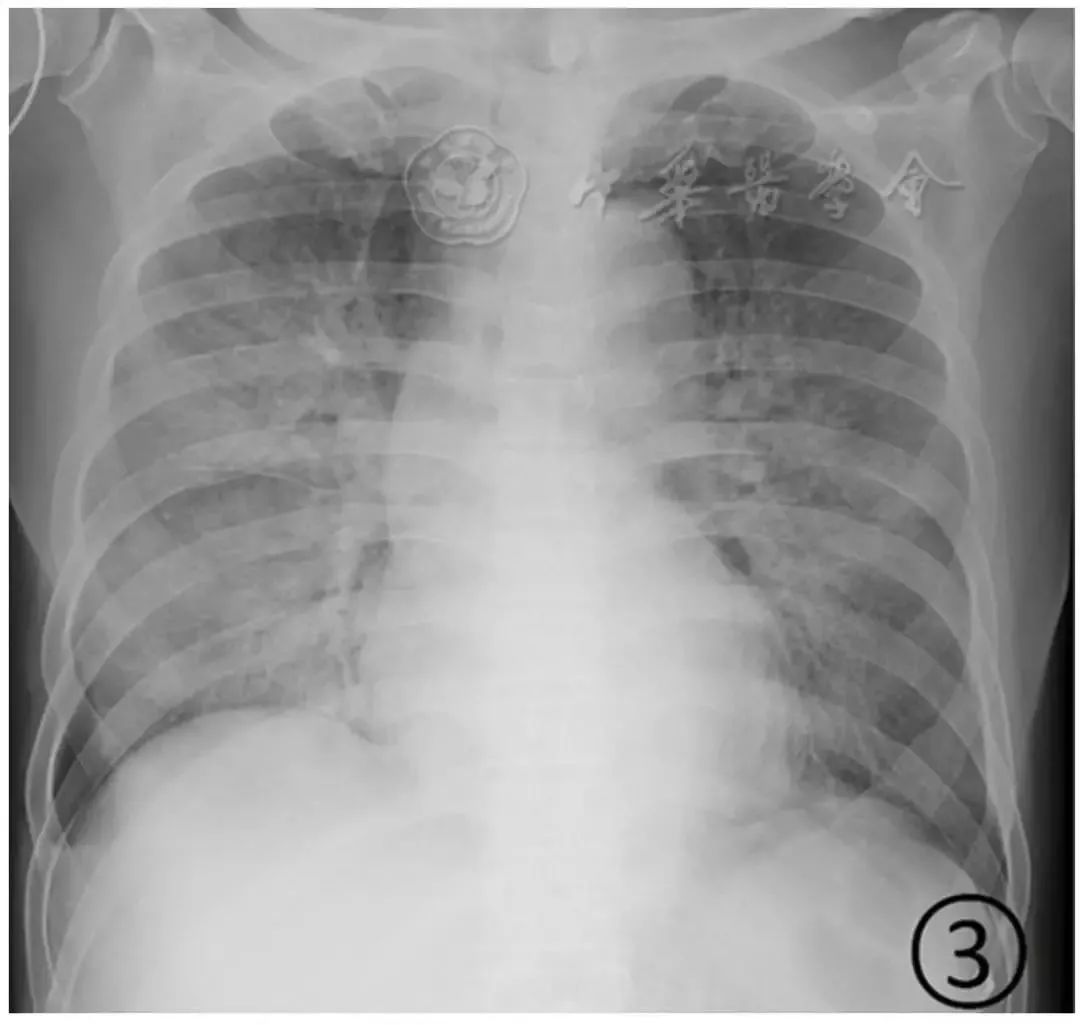 新冠肺炎影像演变过程,新冠肺炎胸部影像学特点有哪些
