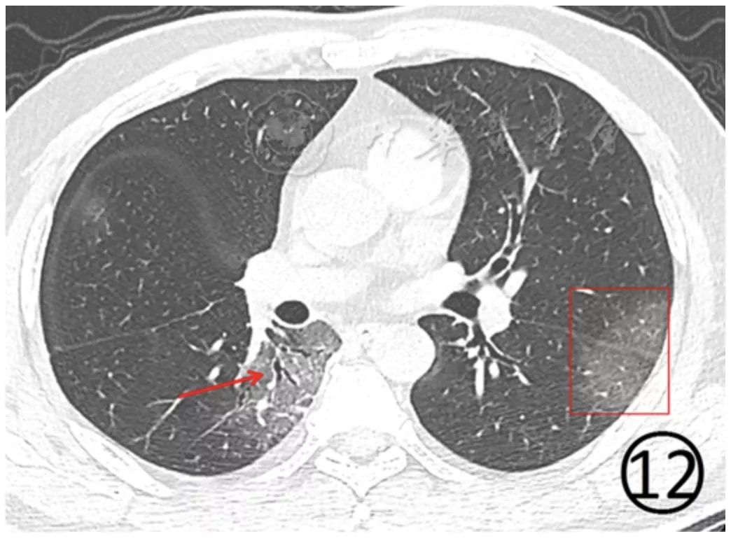 新冠肺炎影像演变过程,新冠肺炎胸部影像学特点有哪些