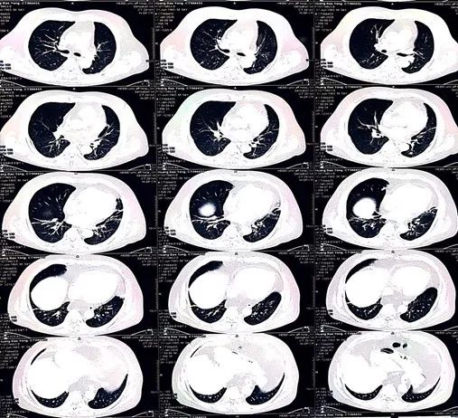 一度房室传导阻滞是怎么得的,三度房室传导阻滞最简单看法