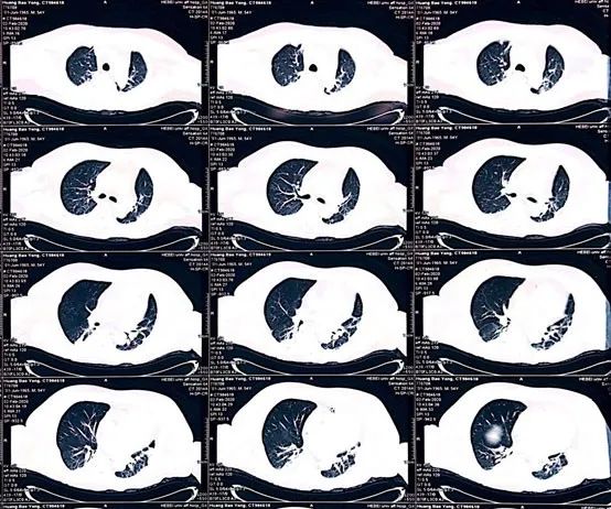 一度房室传导阻滞是怎么得的,三度房室传导阻滞最简单看法