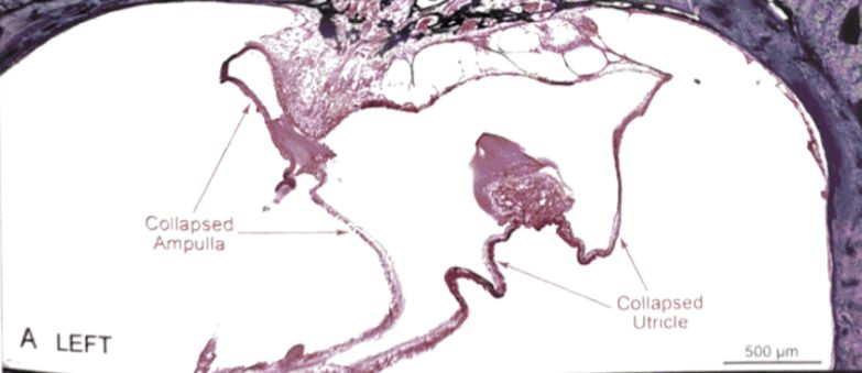 22张图，细说梅尼埃病的组织病理学特点丨“晕”筹帷幄
