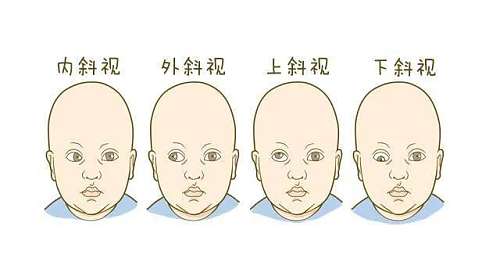 斜视成人还可以治疗吗,斜视引起的弱视还能动手术吗