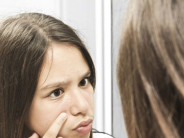 孩子脸上长痘痘怎么调理,脸上长痘痘该怎么调理