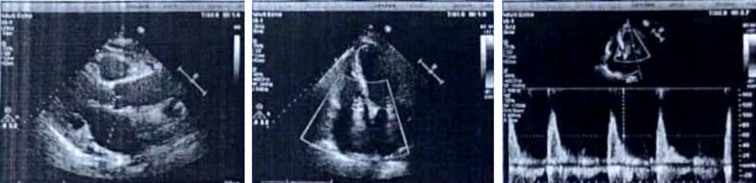 ⼤剂量琥铂酸美托洛尔缓释⽚治疗房颤并⼼衰⼀例