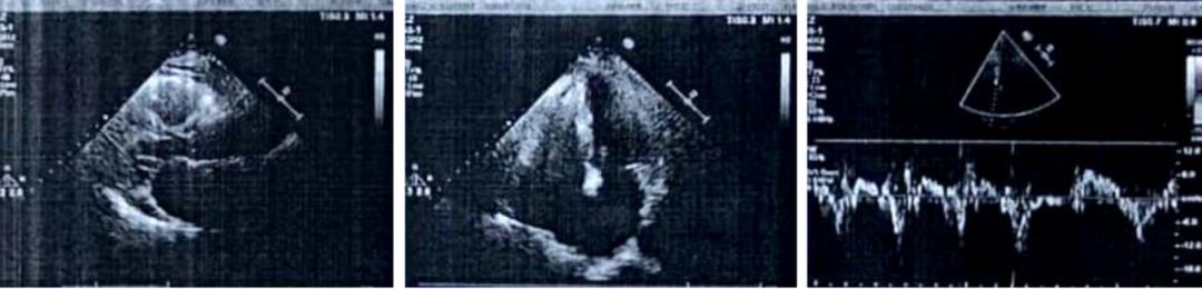 ⼤剂量琥铂酸美托洛尔缓释⽚治疗房颤并⼼衰⼀例