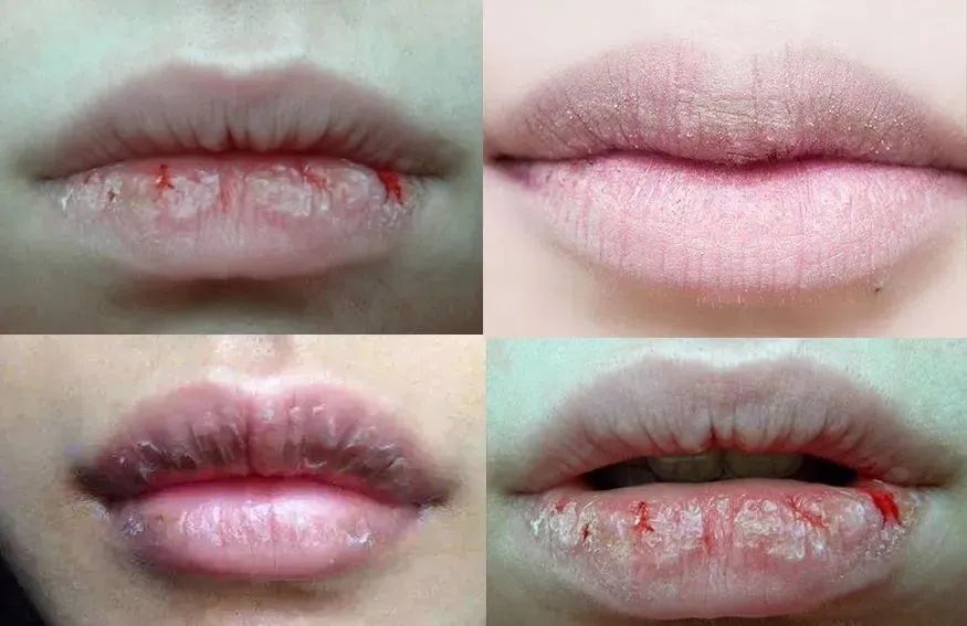 嘴唇干裂起皮等皮掉了涂唇膏,嘴唇干脱皮用什么唇部护理比较好?