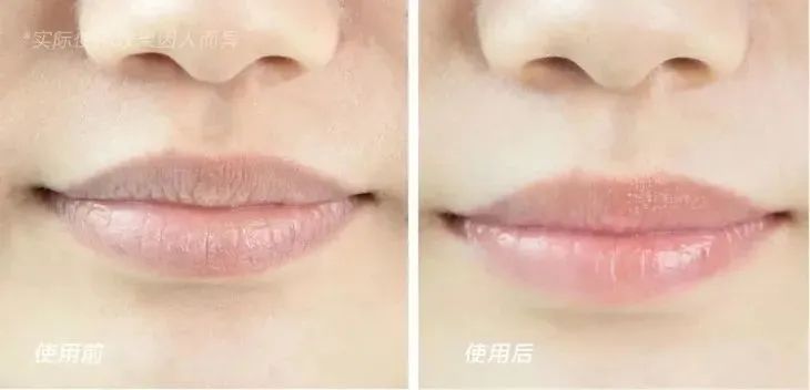 嘴唇干裂起皮等皮掉了涂唇膏,嘴唇干脱皮用什么唇部护理比较好?