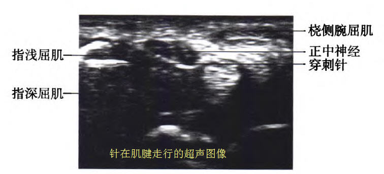 超声波注射治疗腕管综合征效果,超声引导局部注射治疗腕管综合征