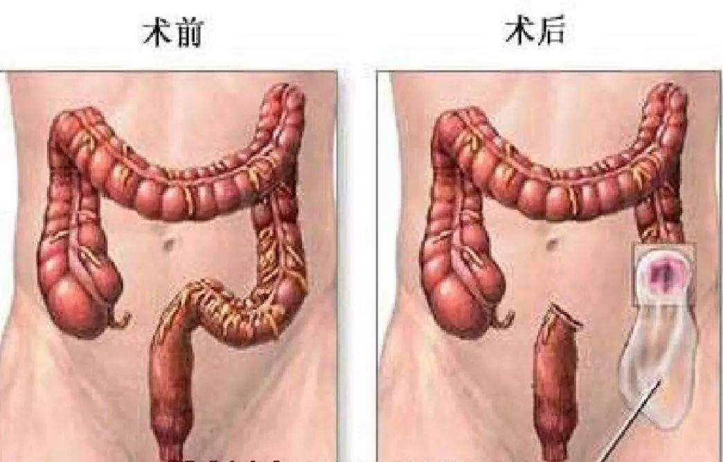 肠造瘘口的护理操作流程,肠造瘘老人饮食护理