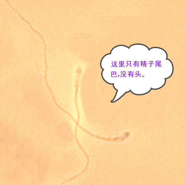 单一畸形精子症,无头精子是头部缺陷精子吗