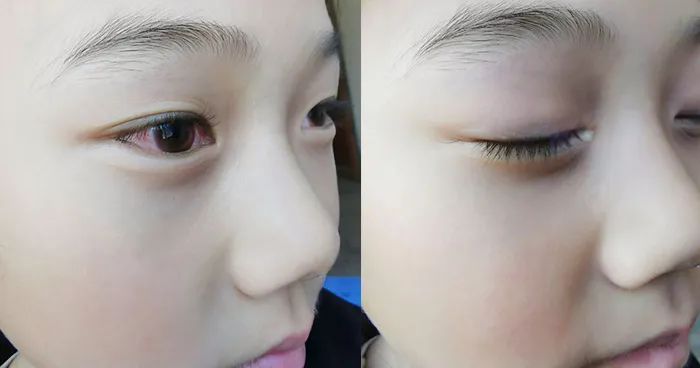 日本专治眼睛模糊的眼药水,护眼蓝光过滤器