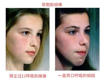 鼻炎太折磨人了怎么治呢,鼻炎折磨人吗