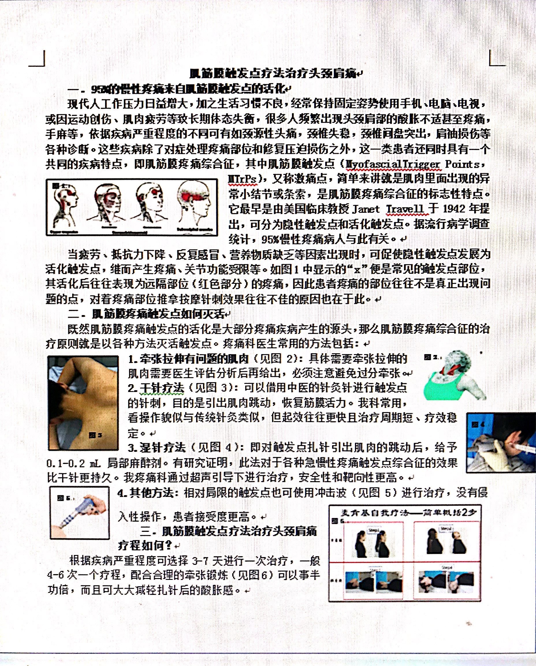 肌筋膜触发点怎么消除,肌筋膜疼痛触发点松解术