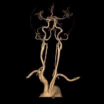 左侧大脑后动脉开窗畸形图片,脑部基底动脉开窗畸形如何治疗