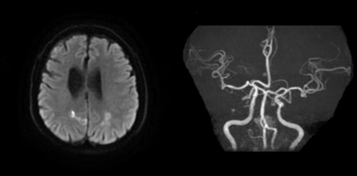 左侧大脑后动脉开窗畸形图片,脑部基底动脉开窗畸形如何治疗