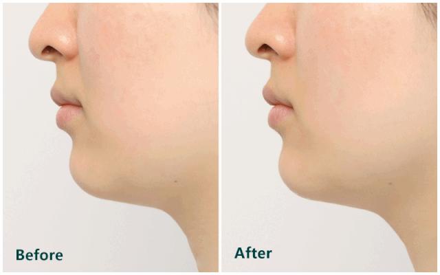 推广一个月没有任何效果,美容院脸部抗衰提拉紧致手法