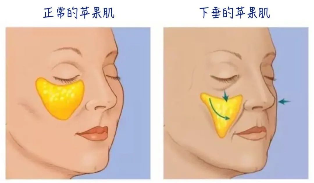 推广一个月没有任何效果,美容院脸部抗衰提拉紧致手法