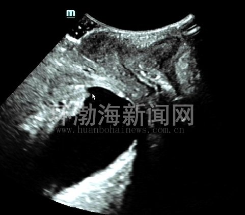唐山工人医院超诊科一项检查解决女性患者多日“尴尬”