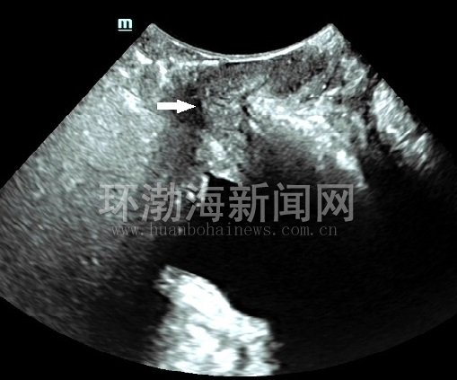 唐山工人医院超诊科一项检查解决女性患者多日“尴尬”