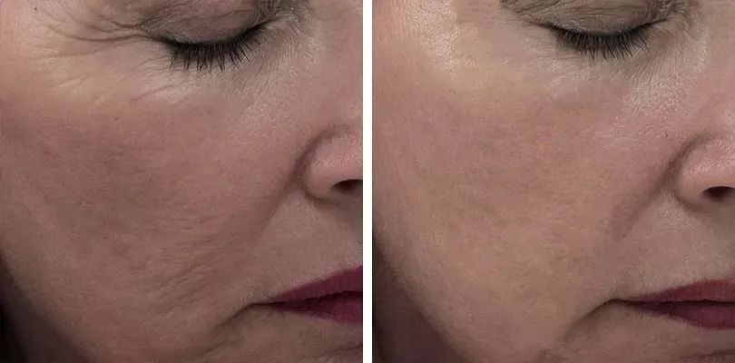 长期补充胶原蛋白的人怎么样了,长期喝胶原蛋白的人最后怎么样了