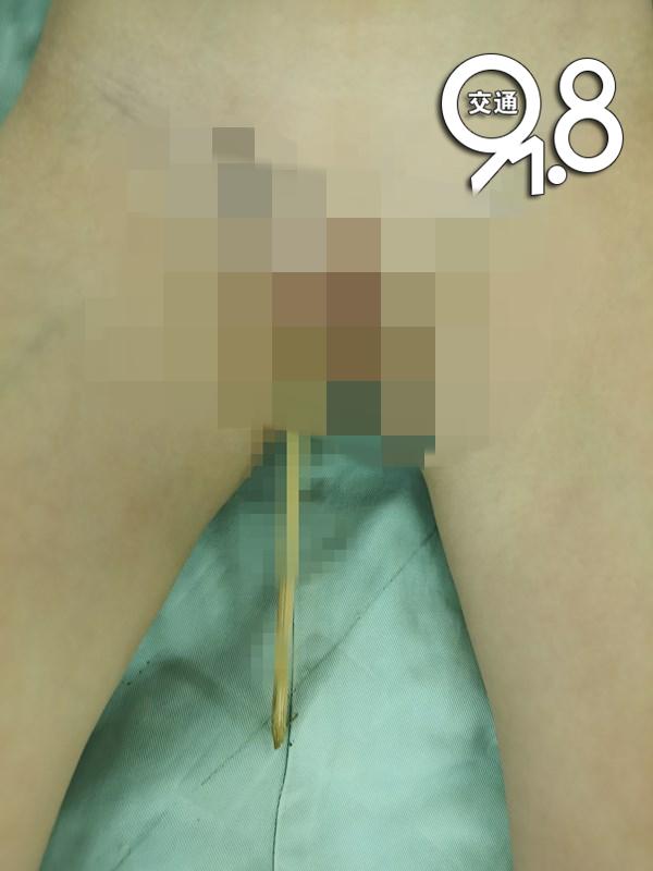 儿童被竹签扎到,3岁女童被竹签刺