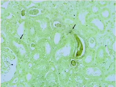 胆汁管型肾病，你听说过吗？