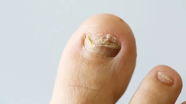 亮甲一般用多久能治好灰指甲,什么药膏能彻底把灰指甲治好