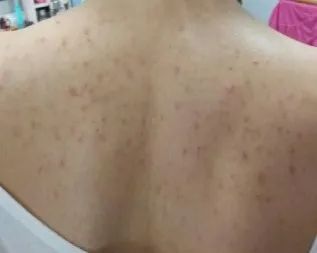 前胸后背都长痘痘全是黑印,背后有痘痘可以穿露背装吗