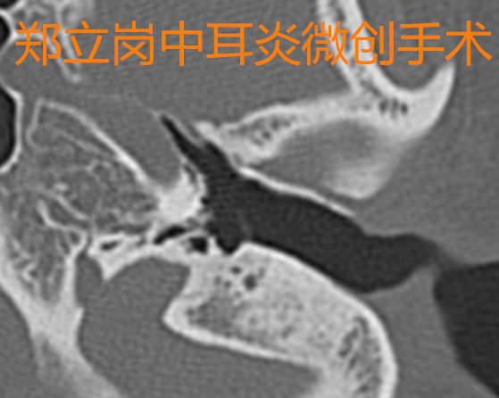 中耳炎鼓膜穿孔微创手术多久恢复,鼓膜穿孔可以不治疗吗