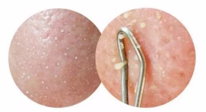 用什么洗脸抑制螨虫生长,用什么洗脸可以抑制螨虫生长