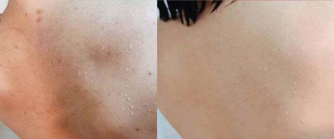 啤酒消痘痘,喝啤酒会消除痘痘吗