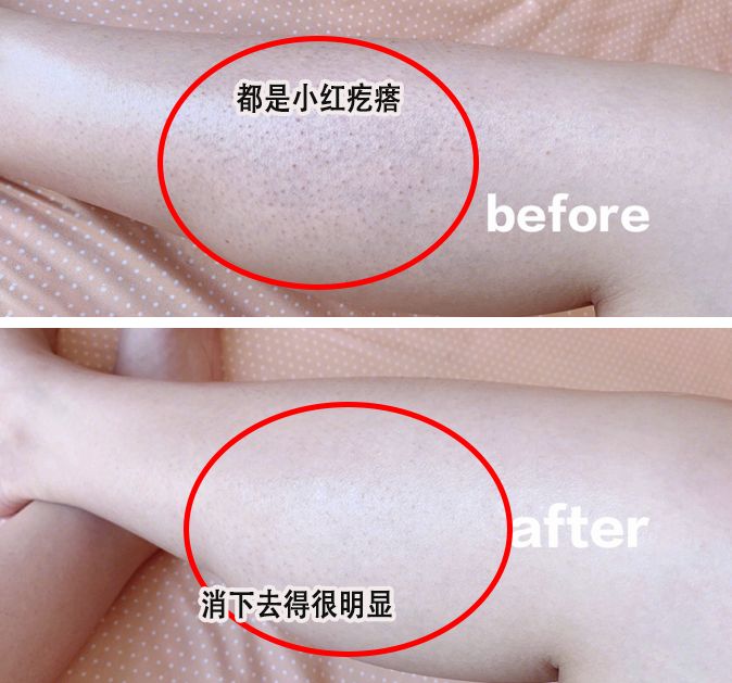 别放弃，烦人的“鸡皮疙瘩”，真的还可以再救一下