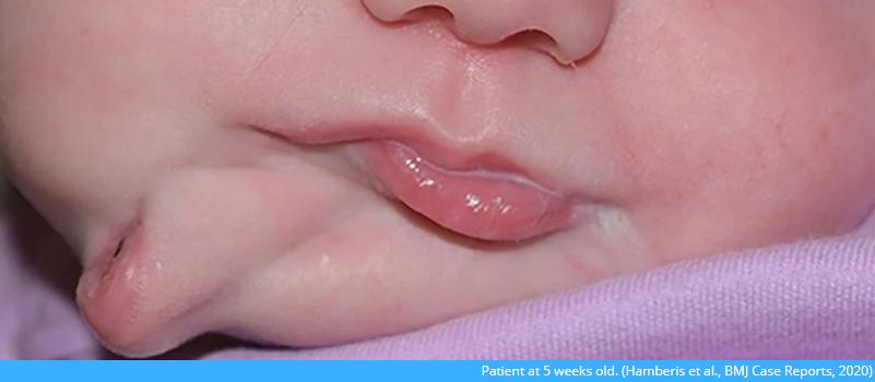 七个月婴儿老张嘴怎么回事,一个婴儿有两张嘴