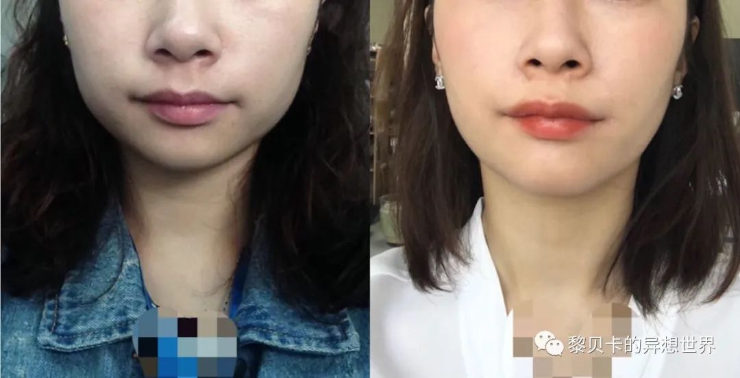 做完医美真的能换脸吗,做完医美需要注意什么